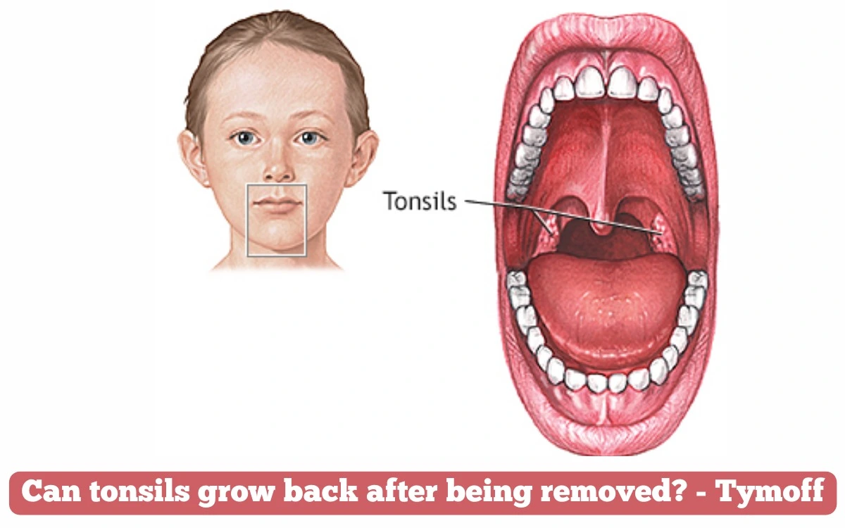 Can tonsils grow back after being removed? - tymoff