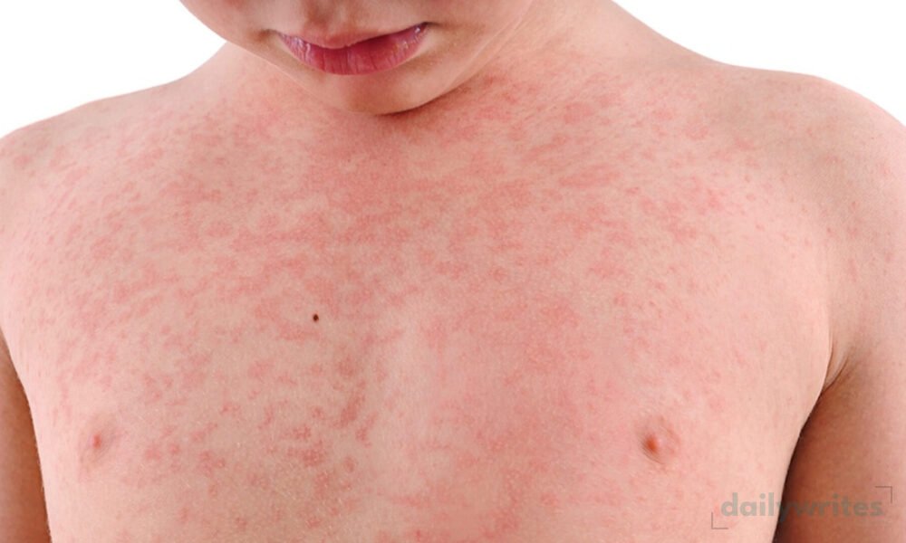 Measles Outbreak
