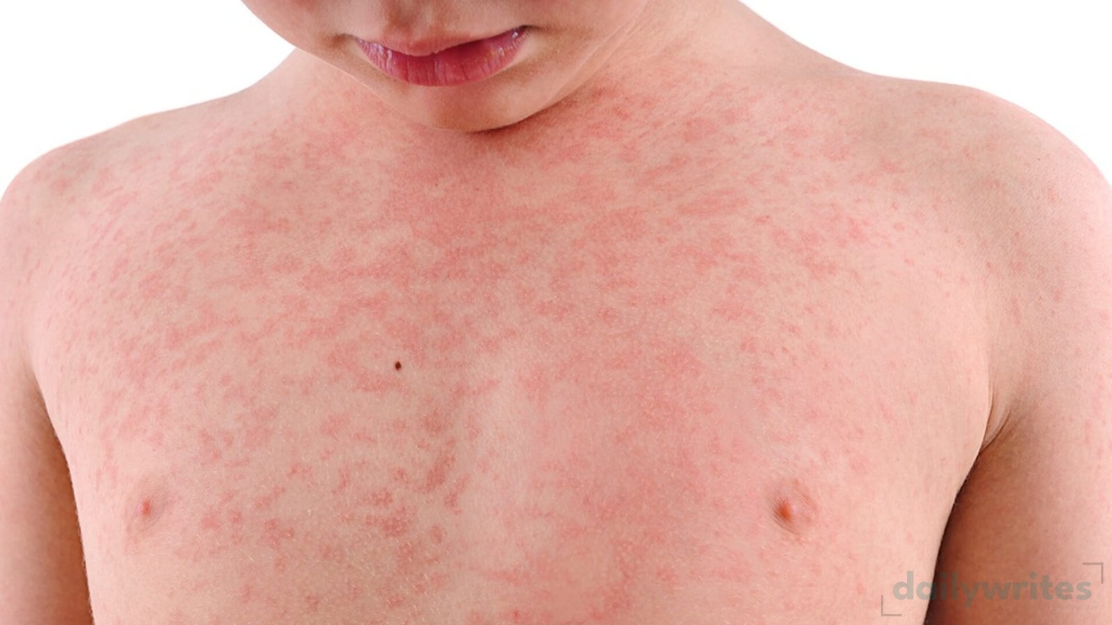 Measles Outbreak